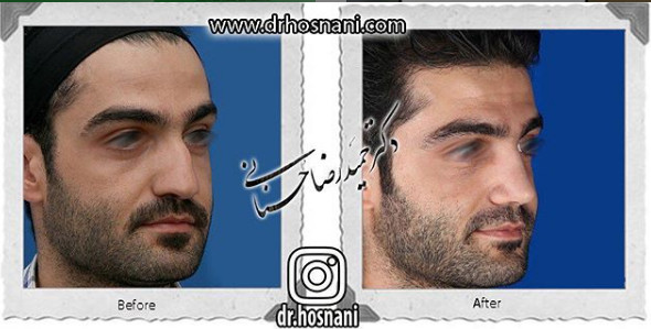 اصلاح انحراف بینی
