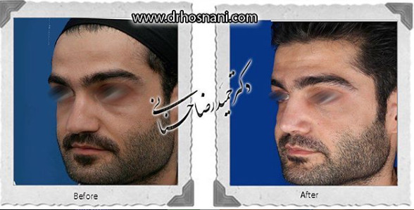 اصلاح انحراف بینی