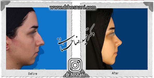 جراحی بینی