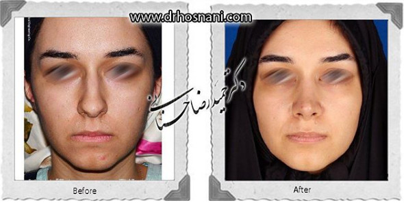 جراحی بینی