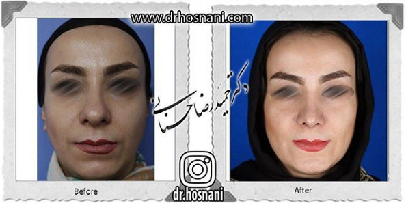  جراحی بینی -846