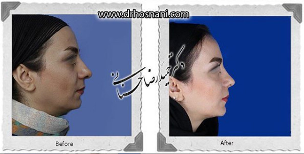  جراحی بینی -847