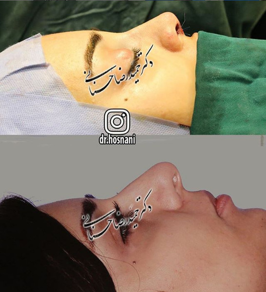 جراحی بینی