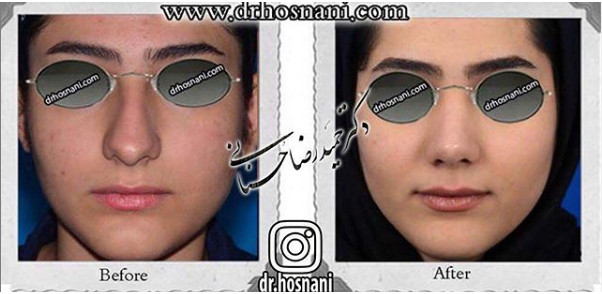 جراحی بینی