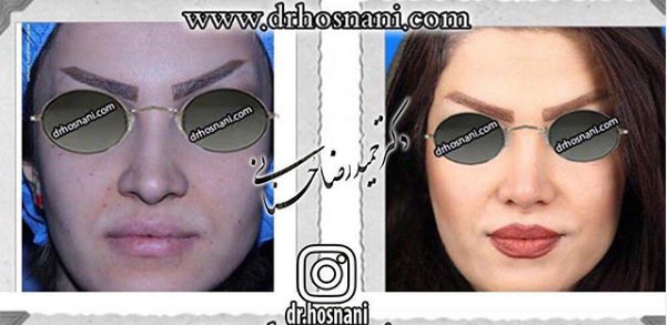  جراحی بینی -851