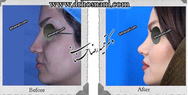  جراحی بینی -852