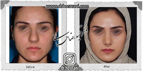 جراحی بینی