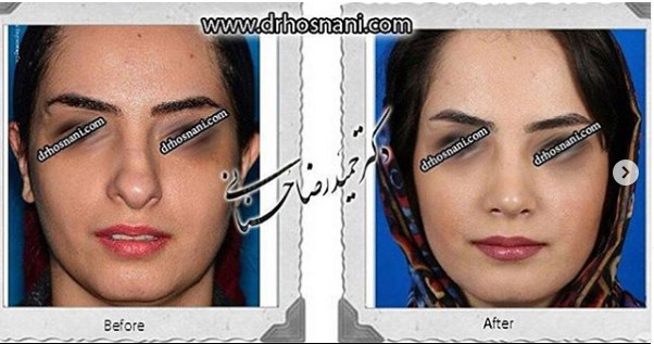 اصلاح انحراف بینی