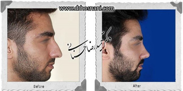  جراحی بینی -857