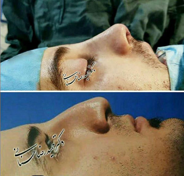 جراحی بینی