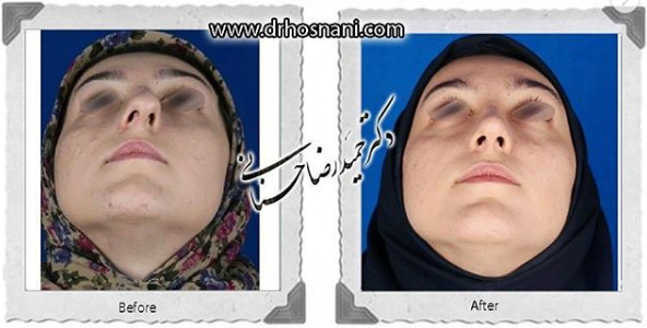 اصلاح انحراف بینی