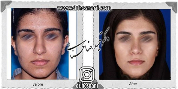 اصلاح انحراف بینی