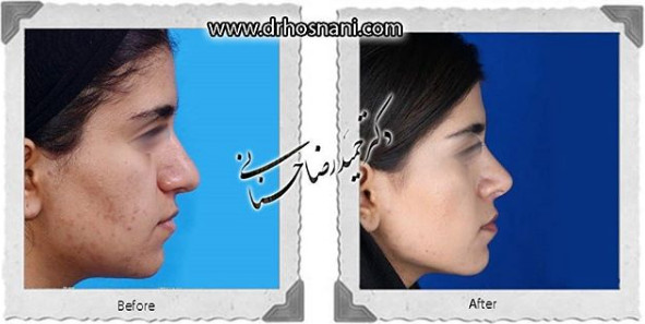 اصلاح انحراف بینی