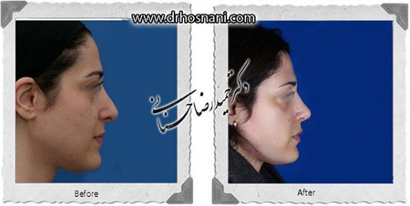 اصلاح انحراف بینی