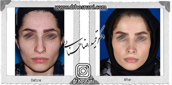  جراحی بینی -871