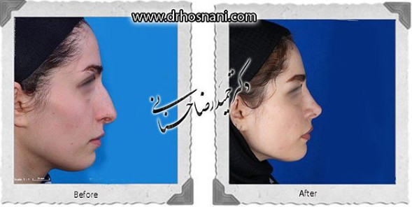  جراحی بینی -872