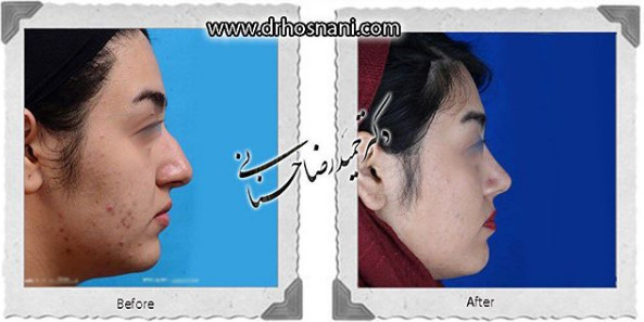 جراحی بینی