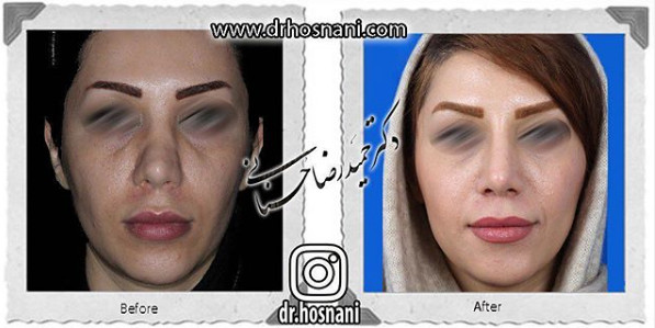 جراحی بینی