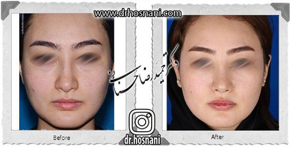 جراحی بینی -877
