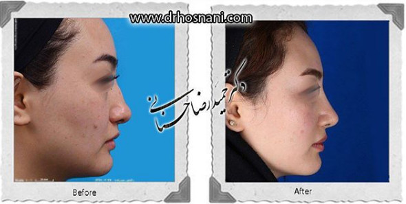 جراحی بینی