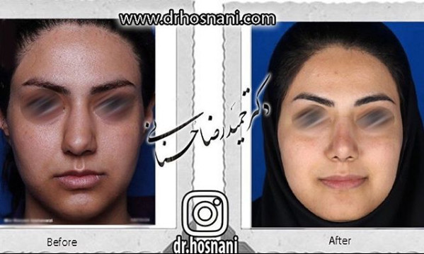 جراحی بینی
