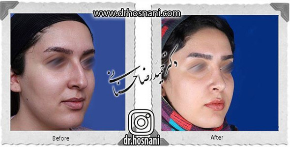 جراحی بینی