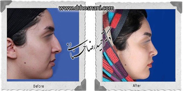 جراحی بینی