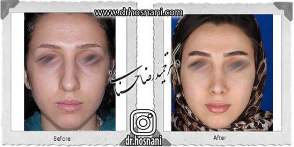 جراحی بینی