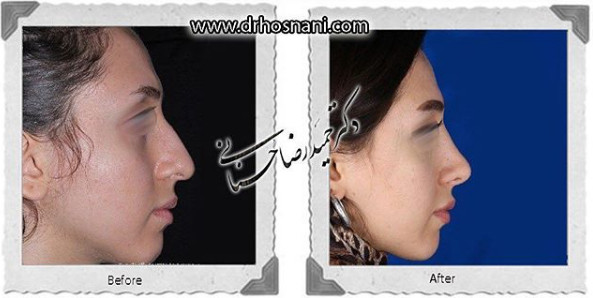  جراحی بینی -886