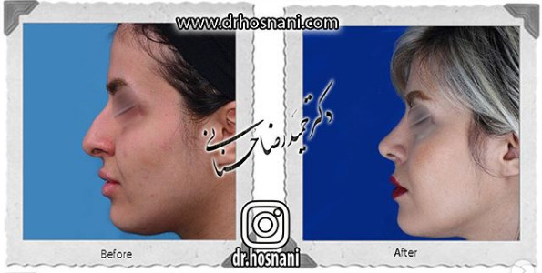  جراحی بینی -887