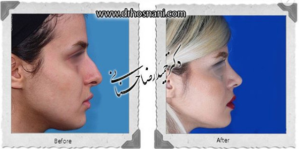  جراحی بینی -888