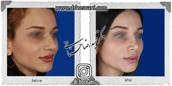 جراحی بینی