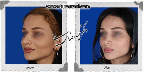 جراحی بینی