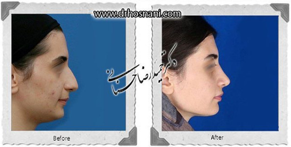 جراحی بینی