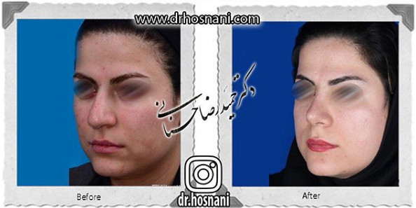  جراحی بینی -895