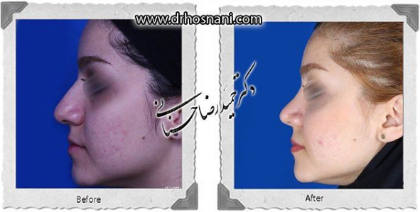 اصلاح انحراف بینی