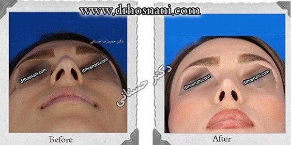  جراحی بینی -902
