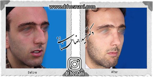 اصلاح انحراف بینی