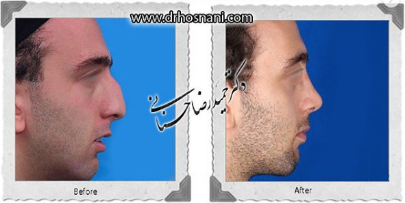 اصلاح انحراف بینی
