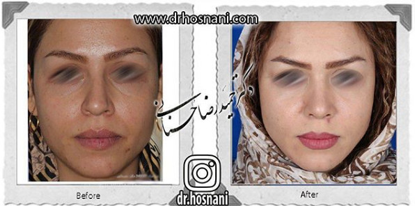 جراحی بینی