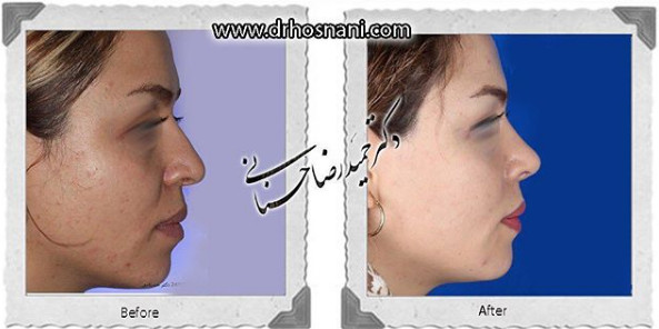  جراحی بینی -906