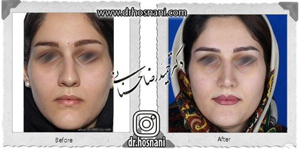 اصلاح انحراف بینی