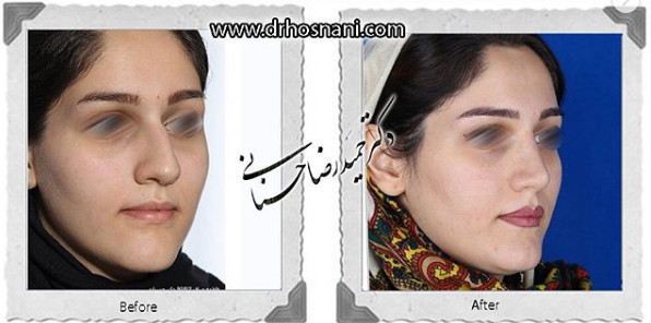 اصلاح انحراف بینی