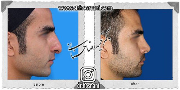 اصلاح انحراف بینی