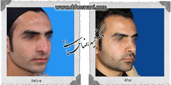 اصلاح انحراف بینی