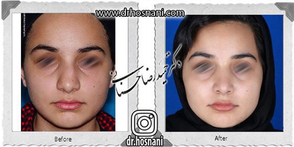 اصلاح انحراف بینی