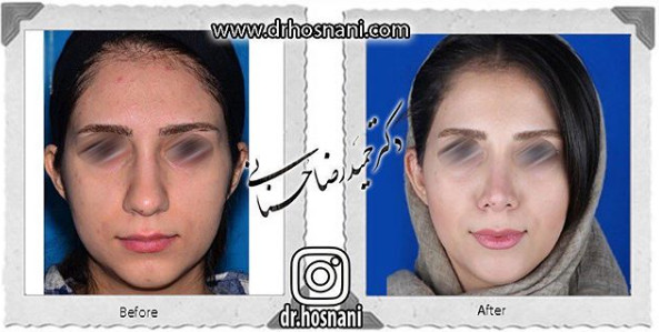 جراحی بینی