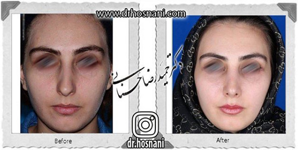 اصلاح انحراف بینی