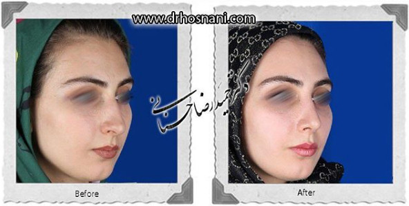 اصلاح انحراف بینی