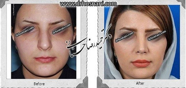 کاهش ارتفاع بینی